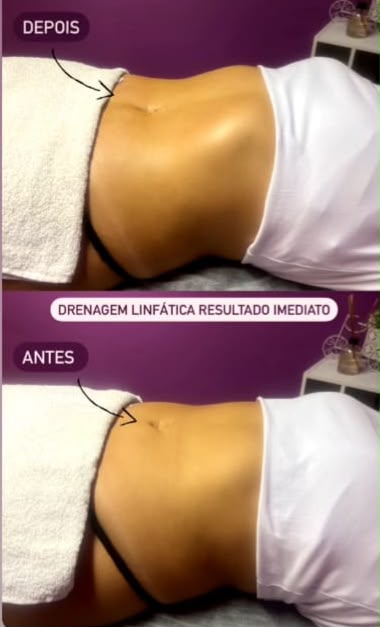 Antes e depois de drenagem linfática